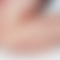 Acrodermatitis papulosa eruptiva infantilis. Disseminierte Aussaat entzündlicher Papeln an den Ex...