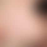 Acrodermatitis papulosa eruptiva infantilis. Wenige Tage altes Exanthem im Gesicht, am Stamm (seh...