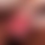 Erythroplasia. sharply defined, lacquer-like erythroplasia with continuous growth in size that ha...