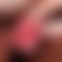 Erythroplasia. sharply defined, lacquer-like erythroplasia with continuous growth in size that ha...