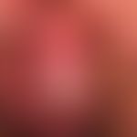 Erythroplasia. erythroplasia existing for years with transition to an invasive penis carcinoma. c...