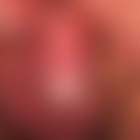 Erythroplasie. Seit Jahren bestehende Erythroplasie mit Übergang in ein invasives Peniskarzinom. ...