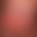 Erythroplasia. 1.5 years of persistent, solitary, chronically dynamic (continuous increase in siz...