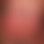 Erythroplasia. 1.5 years of persistent, solitary, chronically dynamic (continuous increase in siz...