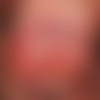 Erythroplasie. Seit 1,5 Jahren persistierende, solitäre, chronisch dynamische (seit 2 Jahren kont...