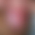 erythroplasia. solitary, chronically dynamic, about 2 cm in size, sharply defined, clearly increa...