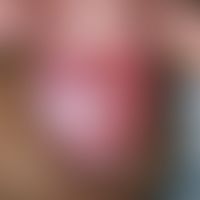 Erythroplasie. Solitäre, chronisch dynamische, etwa 2 cm große, scharf begrenzte, deutlich konsis...