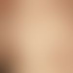 Exanthema subitum. exanthema with centrifugal spread from the trunk to the neck and back of the h...