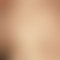 Exanthema subitum. exanthema with centrifugal spread from the trunk to the neck and back of the h...