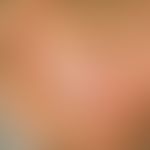 Exfoliatio areata linguae. two circumscribed, almost circular, "plaque free" areas, which, apart ...