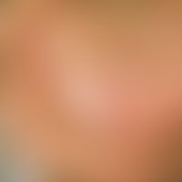 Exfoliatio areata linguae. two circumscribed, almost circular, "plaque free" areas, which, apart ...