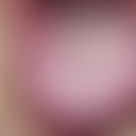 Exfoliatio areata linguae: Chronically dynamic, since 5 years alternating, map-shaped, coating-fr...