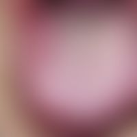 Exfoliatio areata linguae: Chronically dynamic, since 5 years alternating, map-shaped, coating-fr...