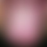 exfoliatio areata linguae. multiple, anular, garland-shaped or landmap-shaped areas free of plaqu...