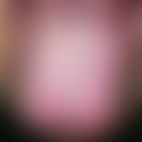 exfoliatio areata linguae. multiple, anular, garland-shaped or landmap-shaped areas free of plaqu...
