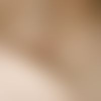 Fasciitis nodularis pseudosarcomatosa. Subkutaner, derber, mit der Unterlage verbackener, zentral...