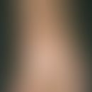Fasciitis, eosinophilic. doughy swelling with formation of a dirty-brown hyperpigmentation and li...
