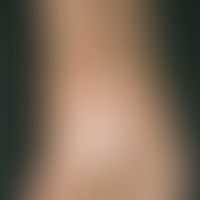 Fasciitis, eosinophilic. doughy swelling with formation of a dirty-brown hyperpigmentation and li...
