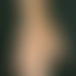 Fasziitis, eosinophile. Teigig derbe Schwellungen mit diffuser Hyperpigmentierung im Bereich des ...