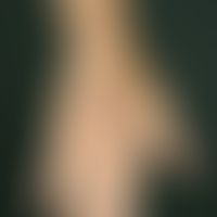 Fasciitis, eosinophilic. doughy rough swellings with diffuse hyperpigmentation in the area of the...