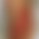 Fasciitis, necrotizing. phlegmonous inflammation with loss of skin, subcutaneous fatty tissue, mu...