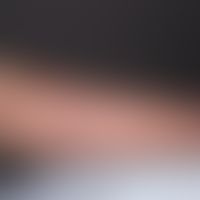 Fasciitis, necrotizing. Condition after split skin transplantation.