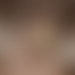 Favus. solitary, acute, approx. 3.0 x 2.5 cm, acutely acute, approx. 3.0 x 2.5 cm in size, locali...