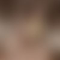 Favus. solitary, acute, approx. 3.0 x 2.5 cm, acutely acute, approx. 3.0 x 2.5 cm in size, locali...
