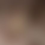 Favus. detailed view of the acutely appeared solitary, plump raised plaque. well visible are the ...