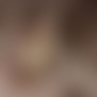 Favus. detailed view of the acutely appeared solitary, plump raised plaque. well visible are the ...