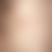 Felty Syndrome. recurrent exanthema with urticarial papules (a few mm to 2 cm in size) in a 35-ye...