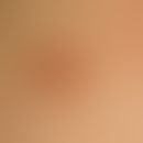 Fibroepithelioma, premalignant, slow-growing, symptom-free, coarse, indolent plaque, which has be...