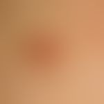 Fibroepitheliom, prämalignes. Seit mehreren Jahren bekannte, langsam wachsende, symptomlose, derb...