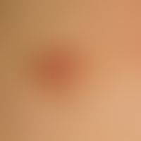 Fibroepithelioma, premalignant, slow-growing, symptom-free, coarse, indolent plaque, which has be...