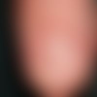 Fibrokeratome, acquired, digital. 3 years old, slightly pressure-sensitive, skin-coloured papule ...