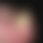 Fibrokeratoma, acquired digital. for about 3 years persistent, slightly progressive, subungual, h...