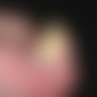 Fibrokeratoma, acquired digital. for about 3 years persistent, slightly progressive, subungual, h...