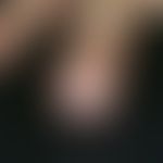 Fibrokeratome, acquired digital. subungual lump on the right ring finger, after trauma, slightly ...