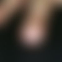 Fibrokeratome, acquired digital. subungual lump on the right ring finger, after trauma, slightly ...