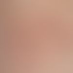 Weiche filiforme Fibroma: &nbsp;Multiple unterschiedlich große, bräunlich rote, weiche&nbsp;Hautp...