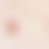 Fibroma pendulans:&nbsp;schmalbasig aufsitzender, weicher, hautfarbener Tumor im Bereich der Achs...