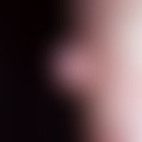 Größeres Fibroma pendulans. Typisches, schmalbasig aufsitzendes, weiches, symptomloses Fibrom.
