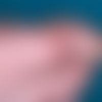 Fibromatosis, digital infantile. detailed enlargement of the findings of the right big toe of the...