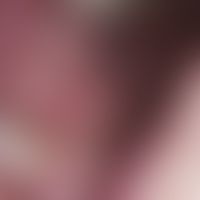 Fibromatosis gingivae (idiopathica). Scharf begrenzter, weicher, nicht druckschmerzhafter, rosafa...