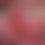 Fibromatosis gingivae (idiopathica): Chronic dynamic, for 6 months existing, noticeably increasin...