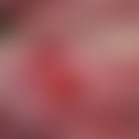 Fibromatosis gingivae (idiopathica). Chronisch dynamischer, seit 6 Monaten bestehender, merklich ...