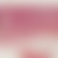 Fibroxanthom, atypisches. Dichtes knotiges Infiltrat das die oberen und mittleren Partien der Der...