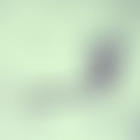 Filariose. Mikrofilarie von Brugia malayi. Im Kopfbereich (Vorderende) fehlen Kerne. Die hellviol...