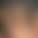 Fingerknöchelpolster, echte. Seit dem 15. Lebensjahr langsam progrediente, schmerzlose Verdickung...