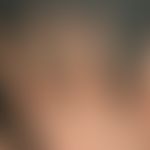 Fingerknöchelpolster, echte. Seit dem 15. Lebensjahr langsam progrediente, schmerzlose Verdickung...